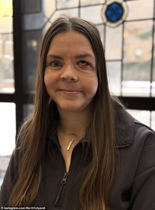 Kenai Mother Reveals Full Severity of Bear Attack Injuries