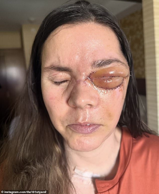 Kenai Mother Reveals Full Severity of Bear Attack Injuries