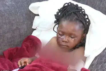 Five-Year-Old Girl Suffers Severe Injuries After Pit Bull Attack in South Bend, Indiana