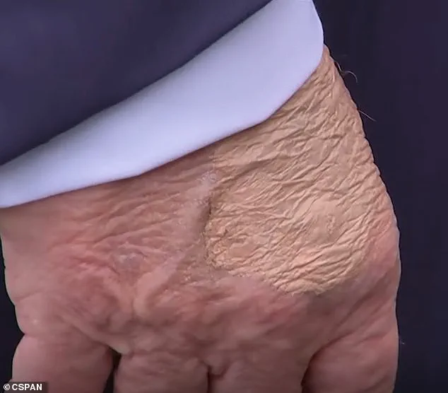 Visible Bruise Sparks Renewed Scrutiny Over President's Health